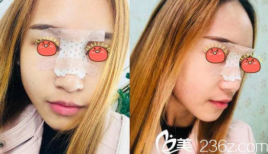 金华玥莱美做完隆鼻3天恢复照 金华玥莱美做完隆鼻3天恢复照