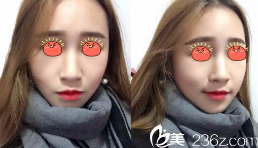 做完玥美生态鼻综合7天恢复照 做完玥美生态鼻综合7天恢复照