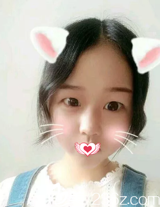 术前单眼皮无神 术前单眼皮无神