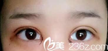 刚做完眼综合眼睛稍肿 刚做完眼综合眼睛稍肿