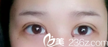 双眼皮恢复7天拆线后消肿 双眼皮恢复7天拆线后消肿