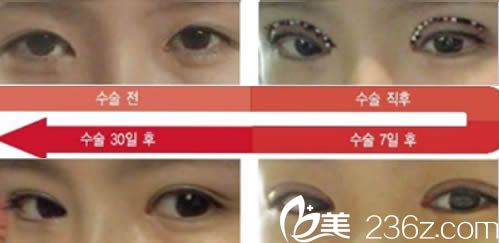 韩国青春整形医院珍珠埋线双眼皮效果图
