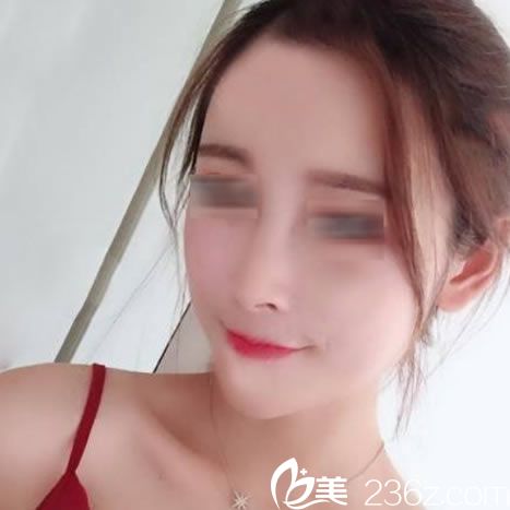 做完自体脂肪填充15天恢复照