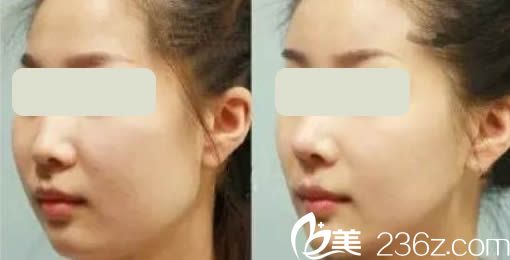 韩国青春整形外科面部轮廓整形案例图