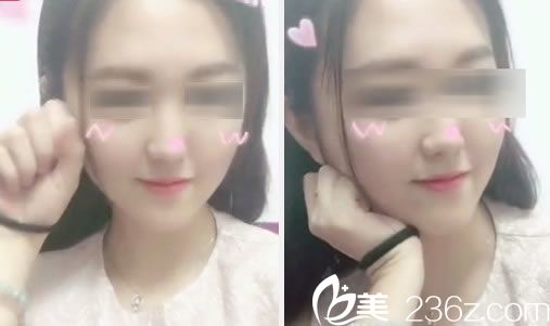 金华玥莱美做脂肪填充30天<span style=