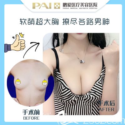 广州鹏爱医疗美容整形医院卢刚隆胸案例图片
