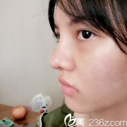 广州鹏爱整形医院卢刚隆鼻和脂肪填充案例八天图片