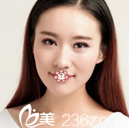 文晶焕双眼皮术后半个月 文晶焕双眼皮术后半个月