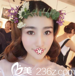 我舍友找韩国IRIS整形外科文晶焕割的韩式双眼皮效果让我心动还行动了。