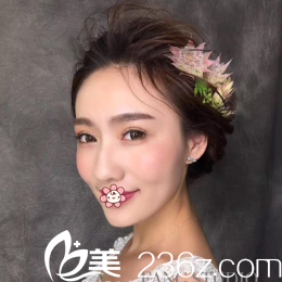 韩国IRIS整形外科文晶焕双眼皮术后40天效果 韩国IRIS整形外科文晶焕双眼皮术后40天效果