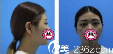 韩国李韩率整形外科李翰率韩式双眼皮真人案例术前照 韩国李韩率整形外科李翰率韩式双眼皮真人案例术前照