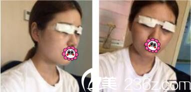 韩国李韩率整形外科李翰率韩式双眼皮真人案例术后天 韩国李韩率整形外科李翰率韩式双眼皮真人案例术后天