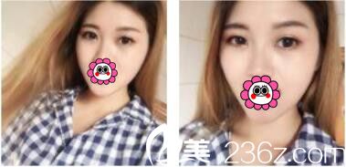 韩国李韩率整形外科李翰率韩式双眼皮真人案例术后十五天 韩国李韩率整形外科李翰率韩式双眼皮真人案例术后十五天