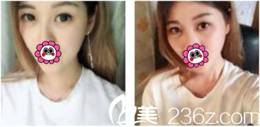 韩国李韩率整形外科李翰率韩式双眼皮真人案例术后一个月 韩国李韩率整形外科李翰率韩式双眼皮真人案例术后一个月