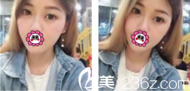 趁着暑期去韩国李韩率做了双眼皮，摆脱双眼皮贴