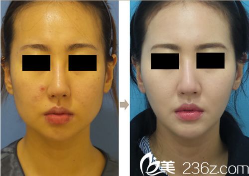 迪美丽魔力V脸吸脂案例对比 迪美丽魔力V脸吸脂案例对比