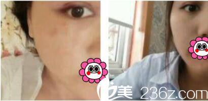 韩国李喜文整形医院李喜文双眼皮真人案例术后第三天 韩国李喜文整形医院李喜文双眼皮真人案例术后第三天