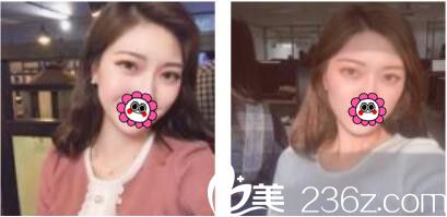 韩国李喜文整形医院李喜文双眼皮真人案例术后一个月 韩国李喜文整形医院李喜文双眼皮真人案例术后一个月