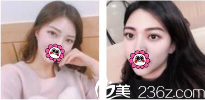 韩国李喜文整形医院李喜文双眼皮真人案例术后六个月 韩国李喜文整形医院李喜文双眼皮真人案例术后六个月