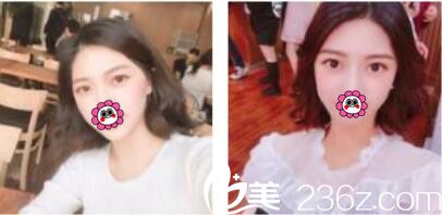 一年前去韩国李喜文做了韩式双眼皮，没想到这么长时间保持的还很好