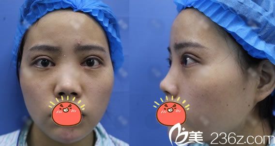 找宁波壹加壹郭光烨做隆鼻前 找宁波壹加壹郭光烨做隆鼻前