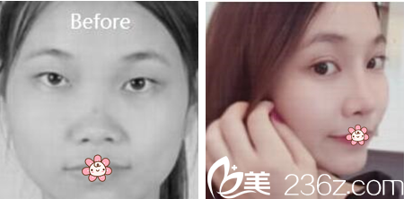 乌鲁木齐伊丽莎白整形张峰医生眼综合实例图