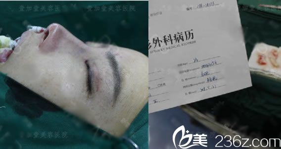 宁波壹加壹刚做完隆鼻的图片 宁波壹加壹刚做完隆鼻的图片