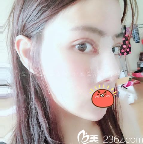 宁波壹加壹郭光烨隆鼻7天<span style= 宁波壹加壹郭光烨隆鼻7天<span style=