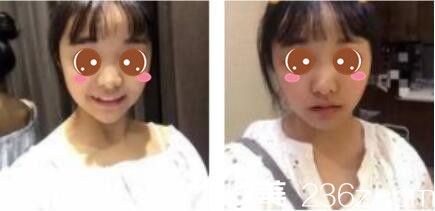 韩国李韩率整形外科李翰率假体隆鼻真人案例术前照 韩国李韩率整形外科李翰率假体隆鼻真人案例术前照