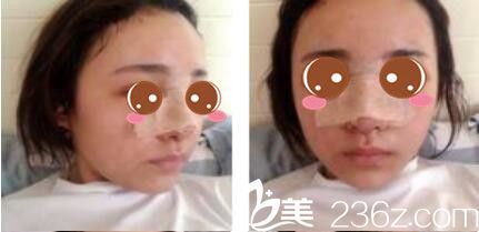 韩国李韩率整形外科李翰率假体隆鼻真人案例术后第三天 韩国李韩率整形外科李翰率假体隆鼻真人案例术后第三天