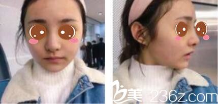 韩国李韩率整形外科李翰率假体隆鼻真人案例术后第七天 韩国李韩率整形外科李翰率假体隆鼻真人案例术后第七天