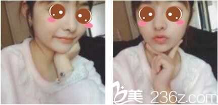 韩国李韩率整形外科李翰率假体隆鼻真人案例术后 一个月 韩国李韩率整形外科李翰率假体隆鼻真人案例术后 一个月