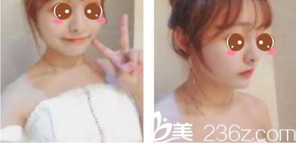 三个月前预约的韩国李韩率做假体隆鼻，现在鼻子恢复的超级自然没有任何不适感