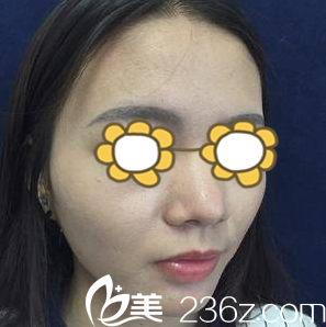 做鼻整形术前照 做鼻整形术前照