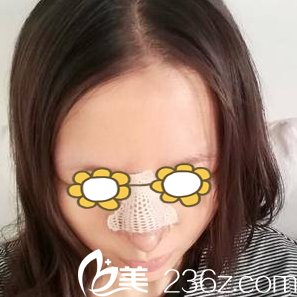 做自体耳软骨隆鼻第五天 做自体耳软骨隆鼻第五天