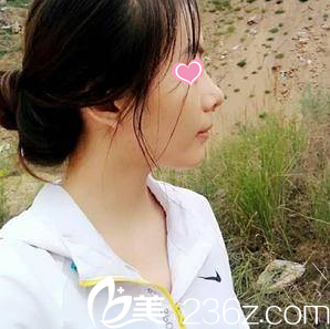 做的鼻整形术后半个月 做的鼻整形术后半个月