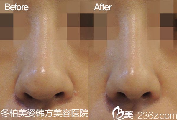 韩国冬柏美姿韩方美容医院鼻部整形前后对比