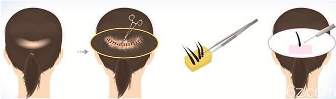 韩国毛尚毛发移植医院毛发移植方法 韩国毛尚毛发移植医院毛发移植方法