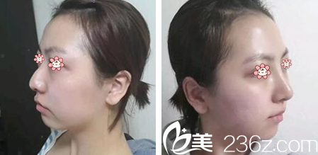 金顺珍院长鹰钩鼻矫正案例 金顺珍院长鹰钩鼻矫正案例