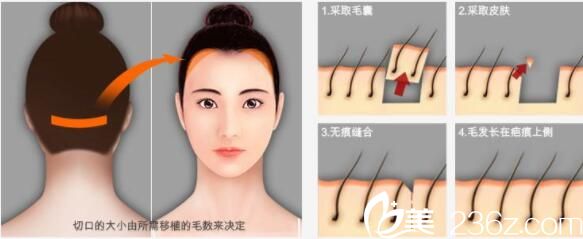 韩国毛尚毛发移植医院朴正一毛发移植