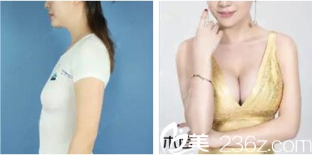 朴真奭院长假体隆胸案例 朴真奭院长假体隆胸案例