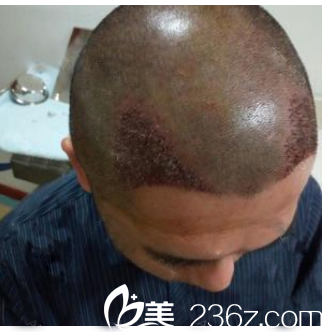 刚找广州壹加壹游凤军做完发际线种植的效果