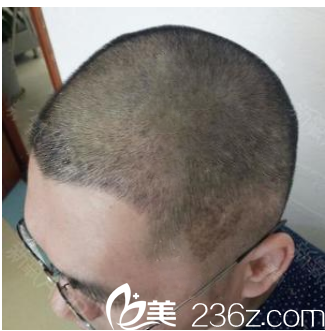 广州壹加壹游凤军发际线种植术后10天效果