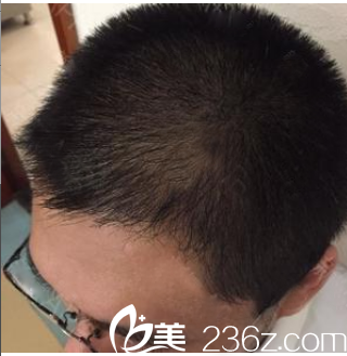 广州植发哪家好？看我花1万多元找广州壹加壹游凤军做的发际线种植效果怎么样