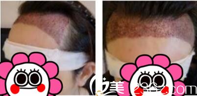 韩国毛尚毛发移植医院朴正一发际线种植真人案例术后第三天