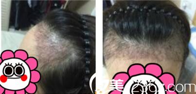 韩国毛尚毛发移植医院朴正一发际线种植真人案例术后十一天