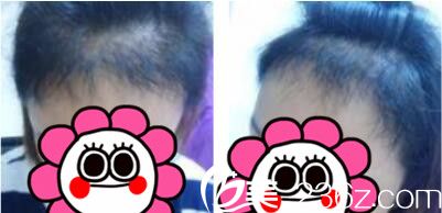 韩国毛尚毛发移植医院朴正一发际线种植真人案例术后三个月