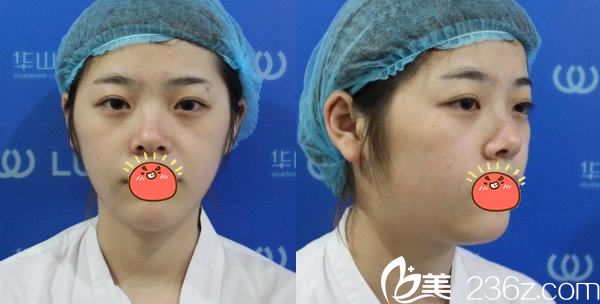 在杭州连天美做脂肪填充前 在杭州连天美做脂肪填充前