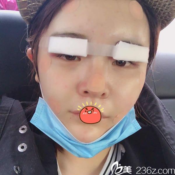 杭州连天美刚做完脂肪填充照片 杭州连天美刚做完脂肪填充照片