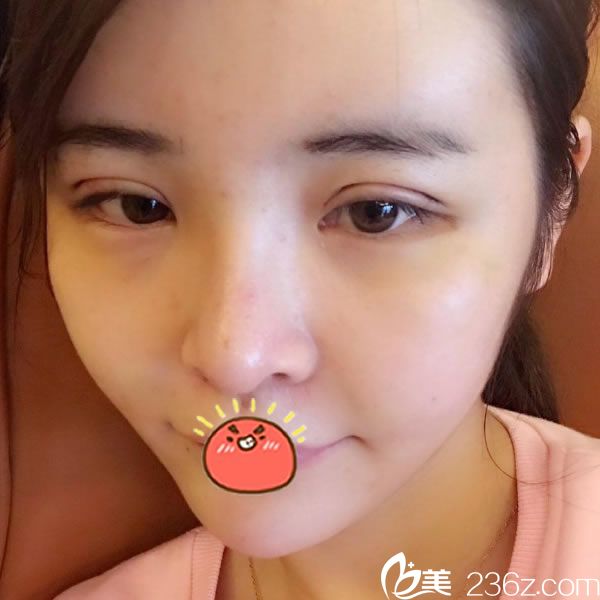 自体脂肪全脸填充和双眼皮6天效果 自体脂肪全脸填充和双眼皮6天效果